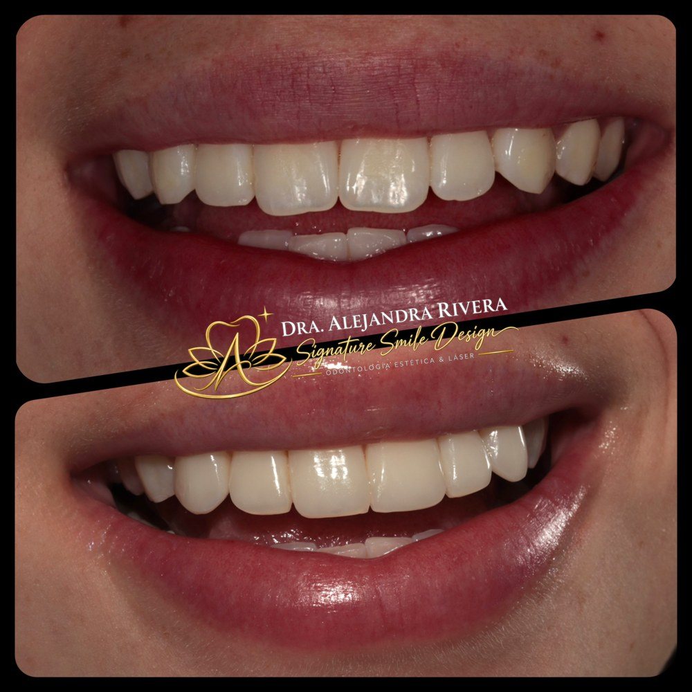 Antes y después de diseño de sonrisa, caso 1