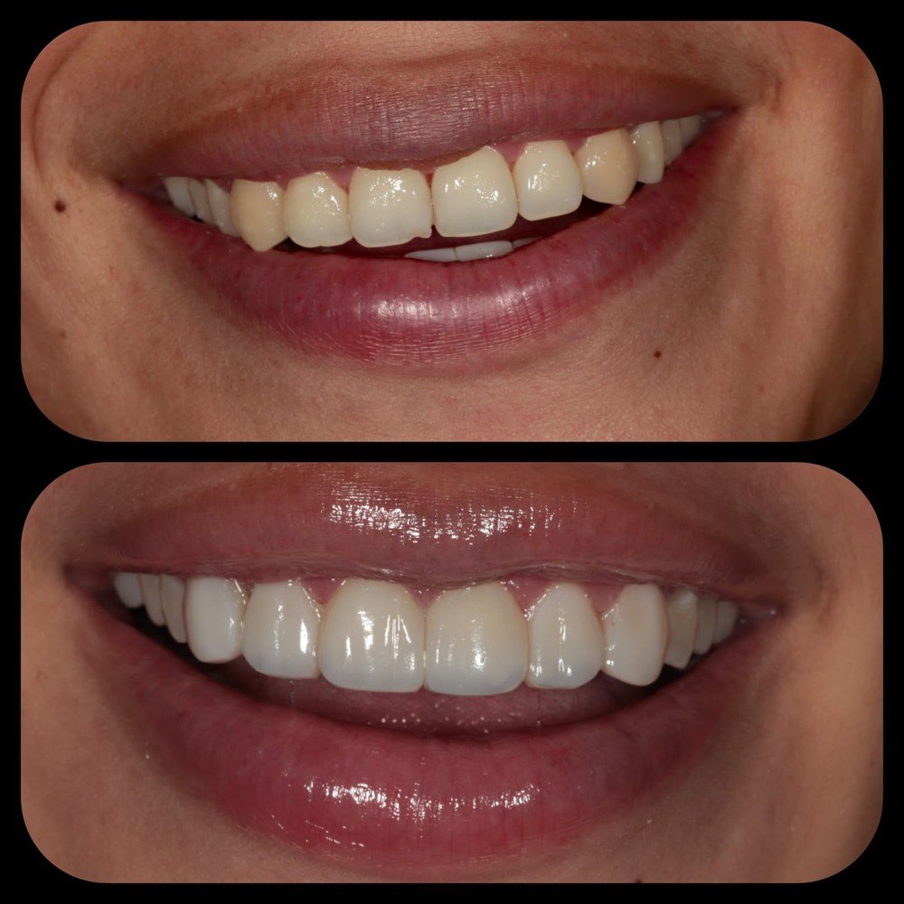 Antes y después de diseño de sonrisa, caso 2