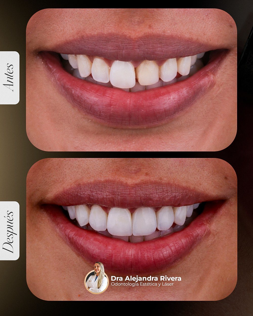 Antes y después de diseño de sonrisa, caso 3